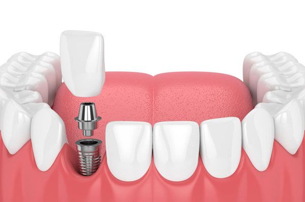 Discover Turkish Dental Care A Clear and Practical Guide for Everyday Patients, Learners, and Health Travelers